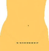 mini tummy tuck